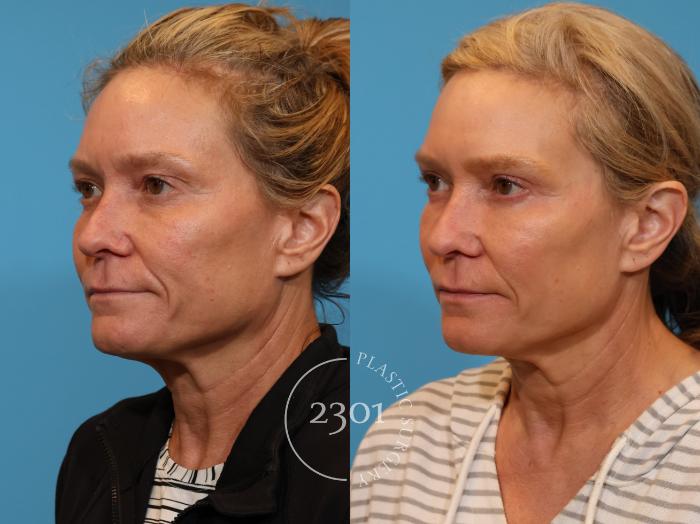Before & After Blepharoplasty Case 936 Left Oblique View in Fort Worth, Plano, & Frisco, Texas