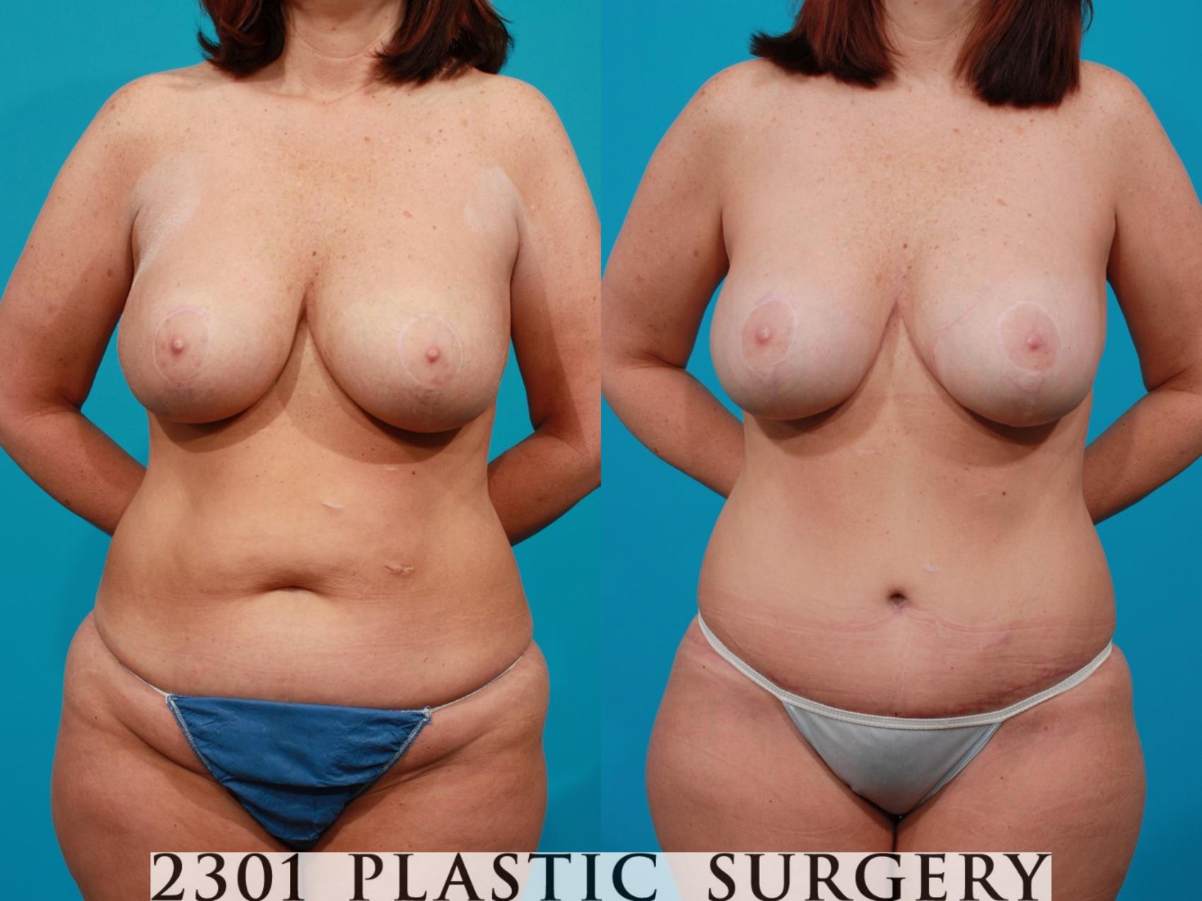 Before & After Post-Bariatric Plastic Surgery Case 114 View #1 View in Fort Worth & Frisco, Texas