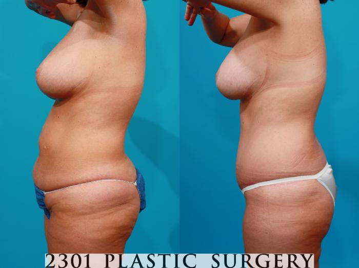 Before & After Post-Bariatric Plastic Surgery Case 114 View #2 View in Fort Worth, Plano, & Frisco, Texas