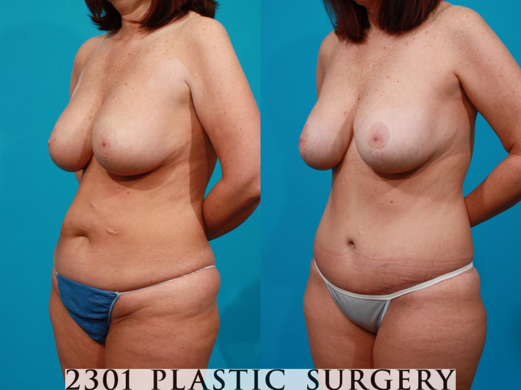 Before & After Body Lift Case 114 View #3 View in Fort Worth & Frisco, Texas