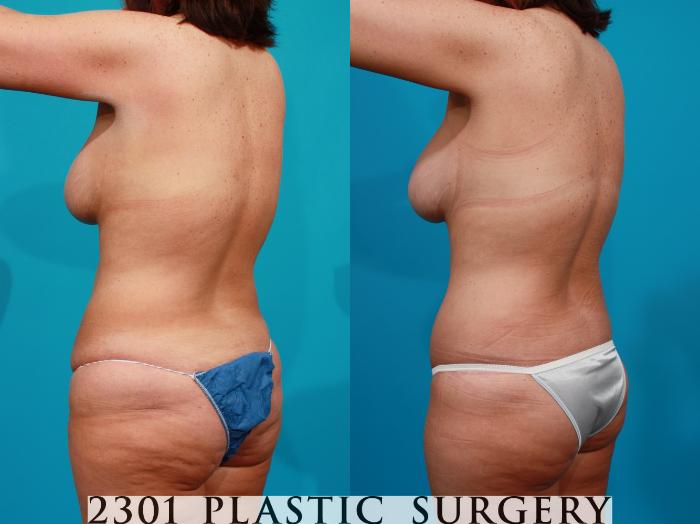Before & After Post-Bariatric Plastic Surgery Case 114 View #4 View in Fort Worth, Plano, & Frisco, Texas