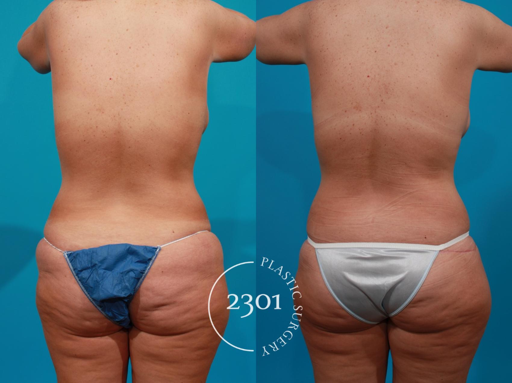 Before & After Post-Bariatric Plastic Surgery Case 114 View #5 View in Fort Worth, Plano, & Frisco, Texas