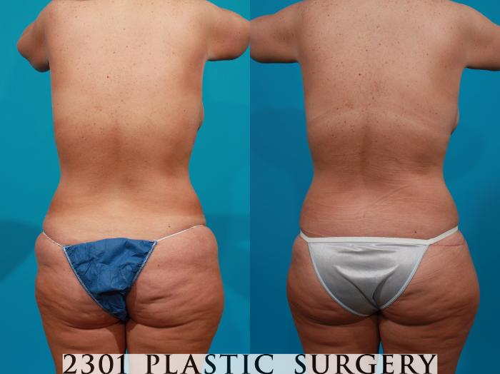 Before & After Post-Bariatric Plastic Surgery Case 114 View #5 View in Fort Worth, Plano, & Frisco, Texas