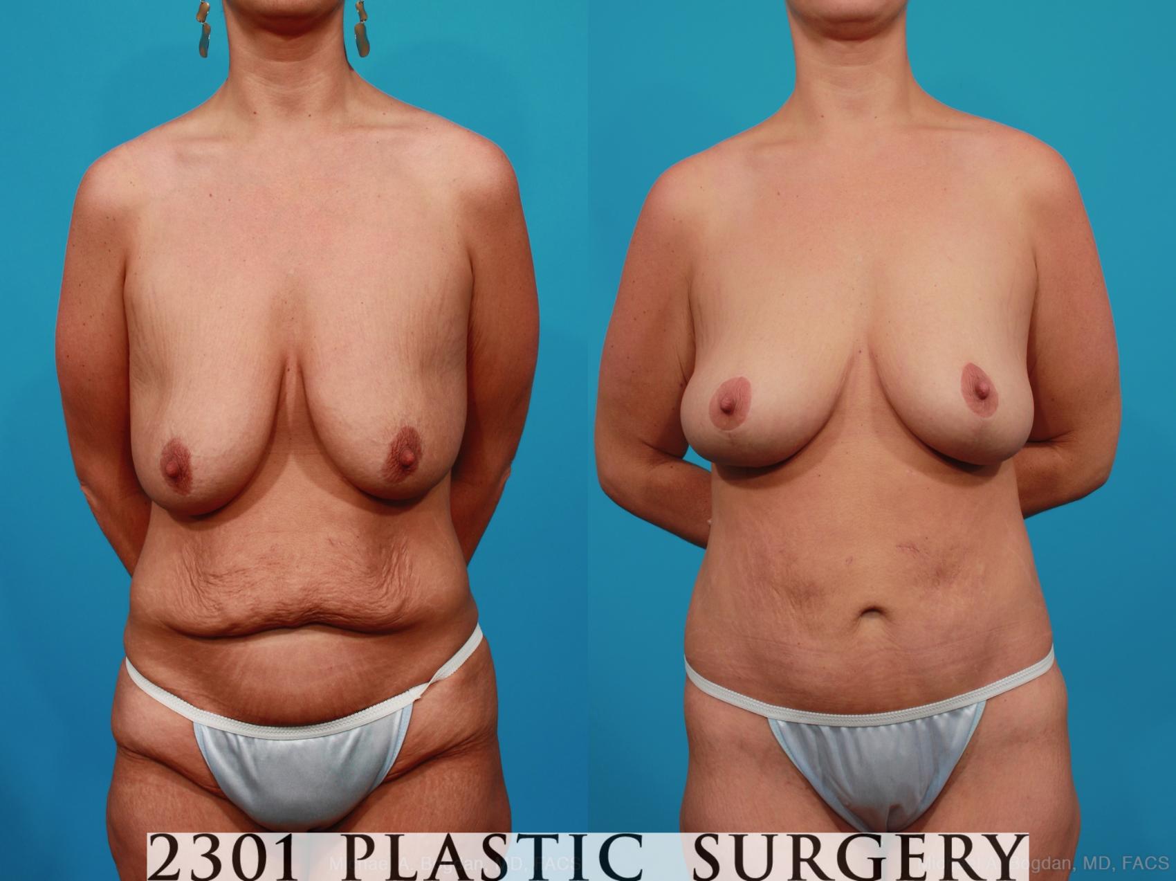 Before & After Breast Lift (Mastopexy) Case 318 View #1 View in Fort Worth & Frisco, Texas