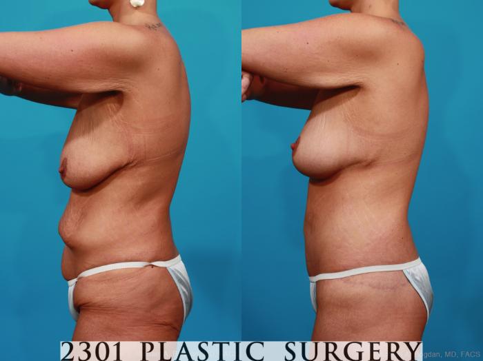 Before & After Body Lift Case 318 View #2 View in Fort Worth, Plano, & Frisco, Texas