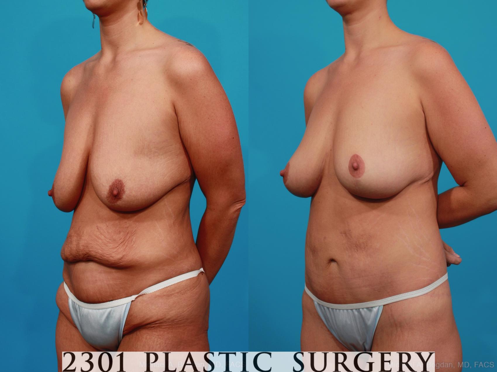 Before & After Body Lift Case 318 View #3 View in Fort Worth & Frisco, Texas