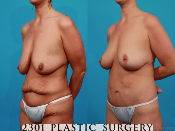 Before & After Breast Lift (Mastopexy) Case 318 View #3 View in Fort Worth, Plano, & Frisco, Texas