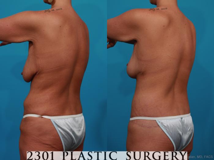 Before & After Breast Lift (Mastopexy) Case 318 View #4 View in Fort Worth, Plano, & Frisco, Texas