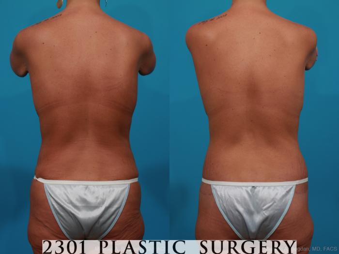 Before & After Breast Lift (Mastopexy) Case 318 View #5 View in Fort Worth, Plano, & Frisco, Texas