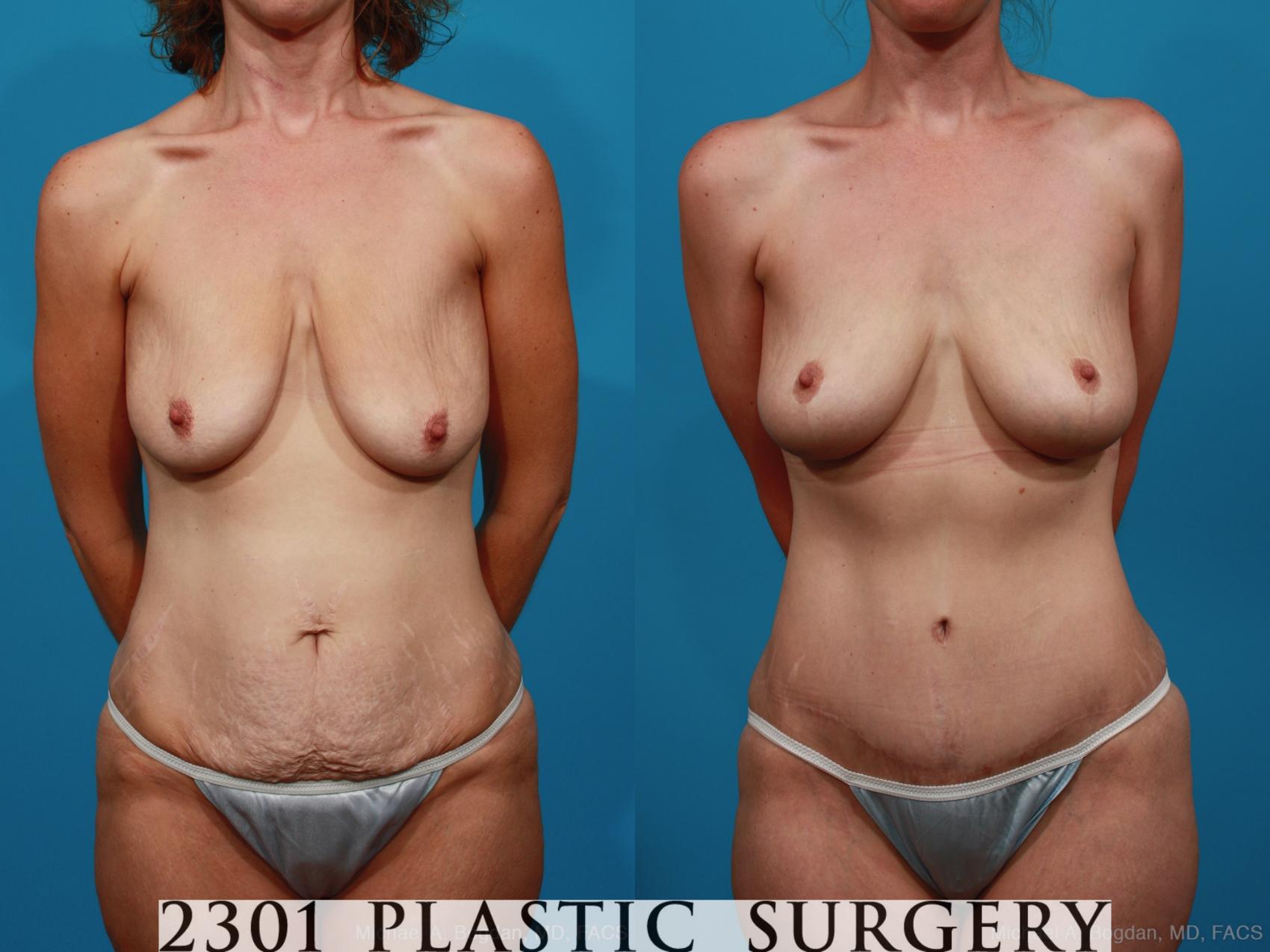 Before & After Breast Lift (Mastopexy) Case 337 View #1 View in Fort Worth, Plano, & Frisco, Texas