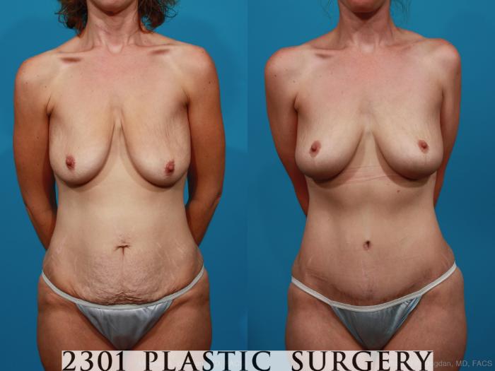 Before & After Body Lift Case 337 View #1 View in Fort Worth & Frisco, Texas