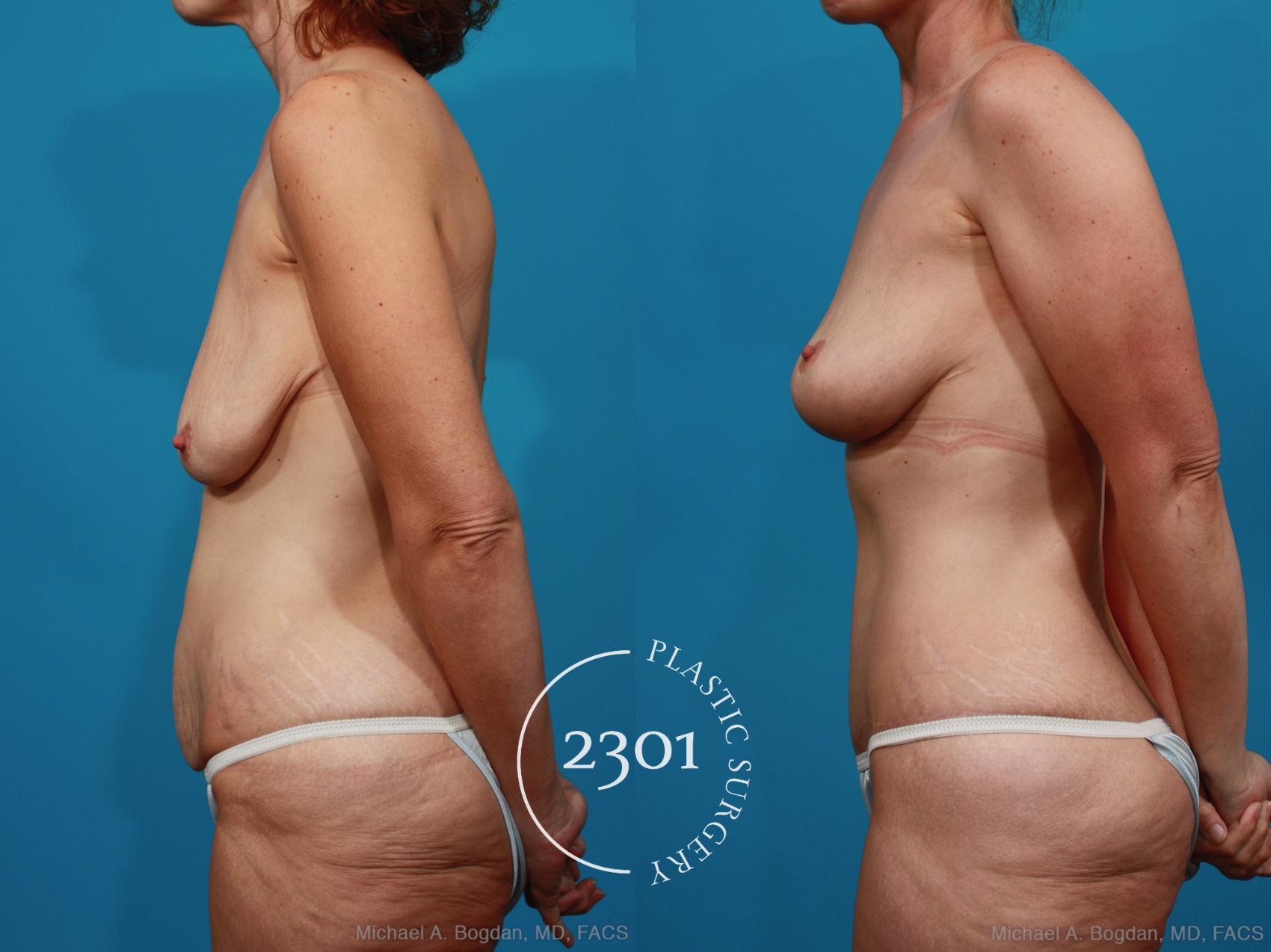 Before & After Body Lift Case 337 View #2 View in Fort Worth, Plano, & Frisco, Texas