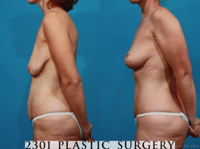 Before & After Breast Lift (Mastopexy) Case 337 View #2 View in Fort Worth, Plano, & Frisco, Texas