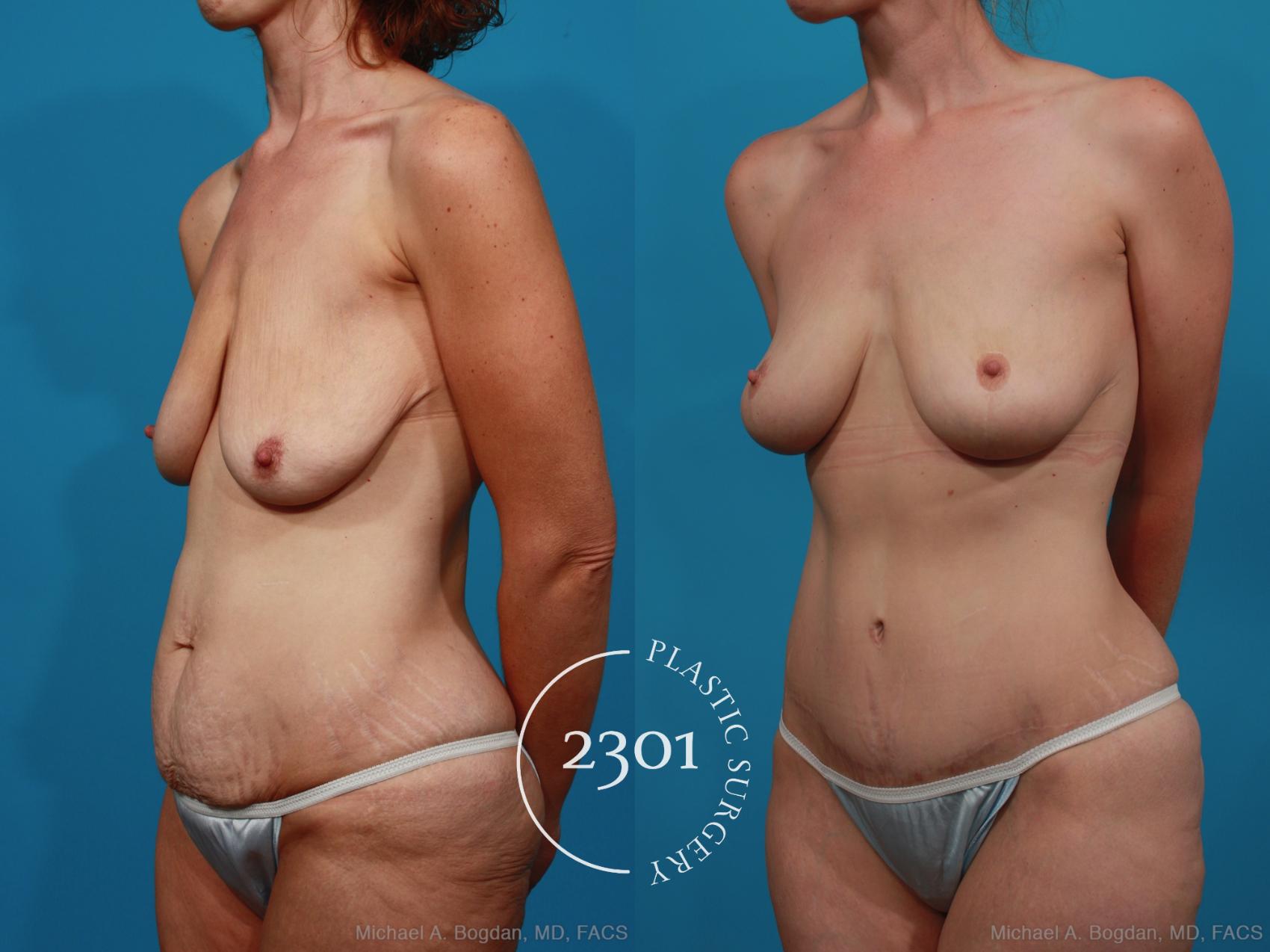 Before & After Body Lift Case 337 View #3 View in Fort Worth, Plano, & Frisco, Texas