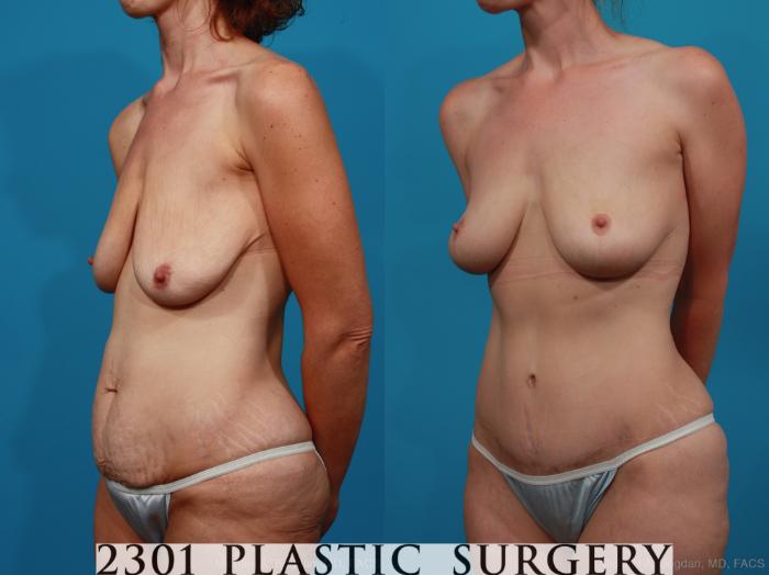 Before & After Breast Lift (Mastopexy) Case 337 View #3 View in Fort Worth, Plano, & Frisco, Texas