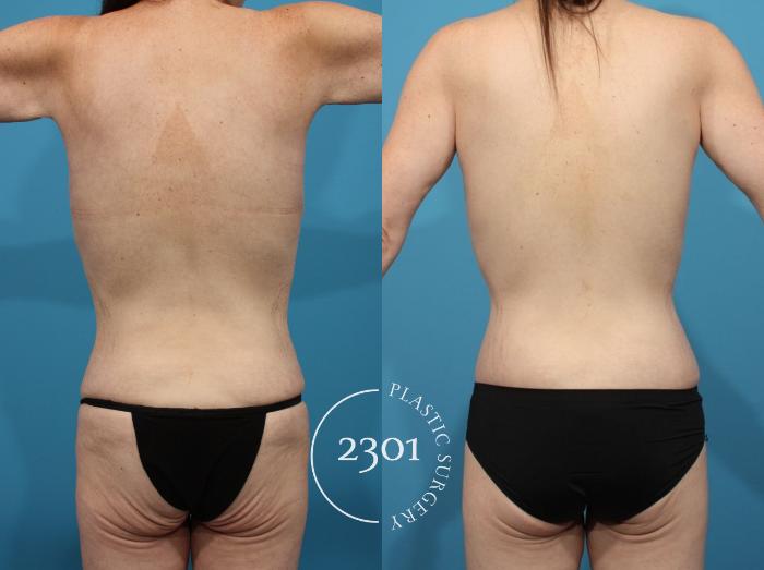 Before & After Body Lift Case 807 Back View in Fort Worth, Plano, & Frisco, Texas