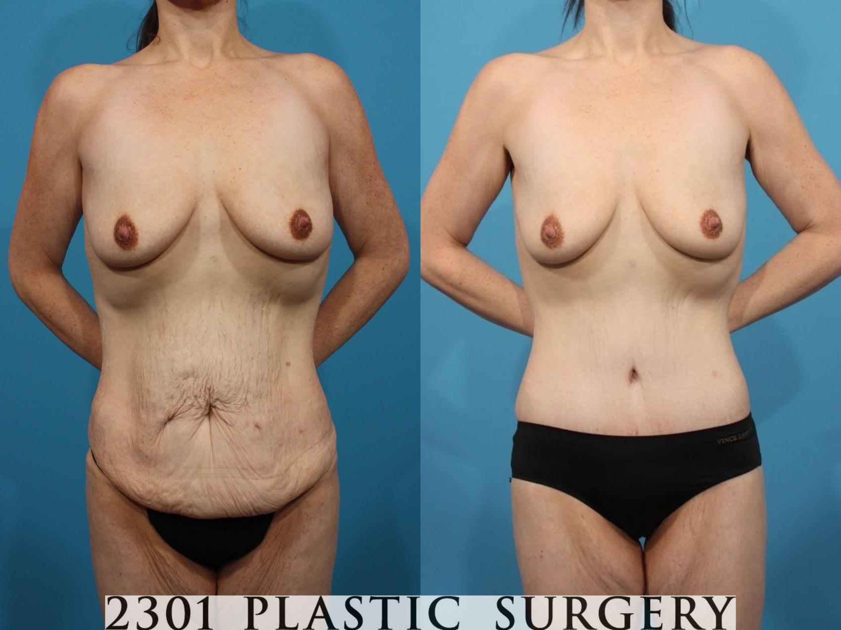 Before & After Body Lift Case 807 Front View in Fort Worth, Plano, & Frisco, Texas