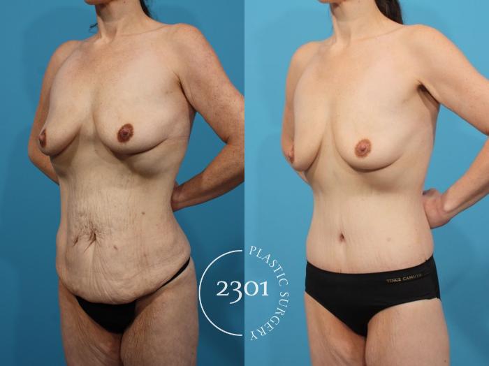 Before & After Body Lift Case 807 Left Oblique View in Fort Worth, Plano, & Frisco, Texas