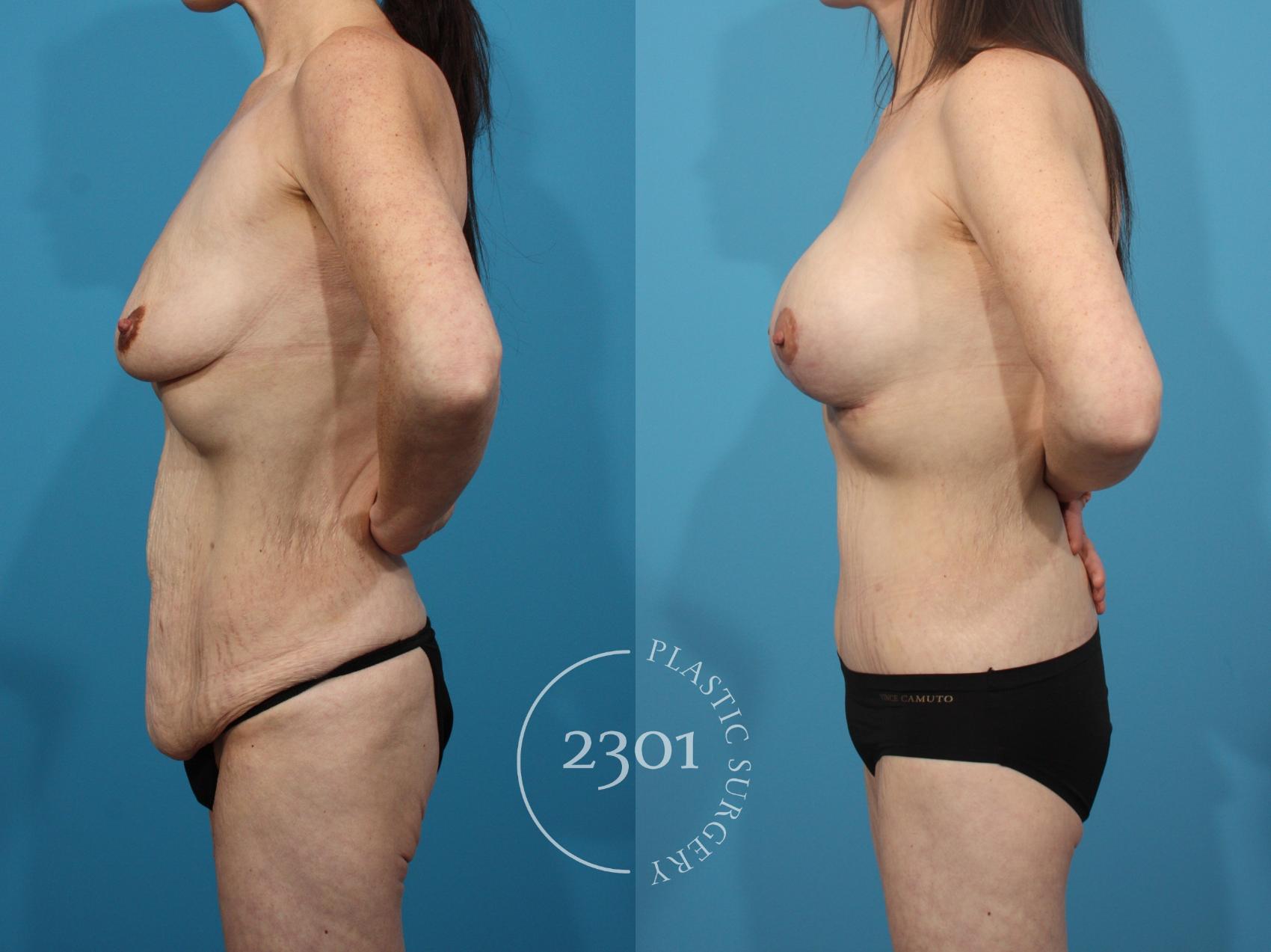 Before & After Mastopexy & Augmentation Case 807 Left Side View in Fort Worth, Plano, & Frisco, Texas