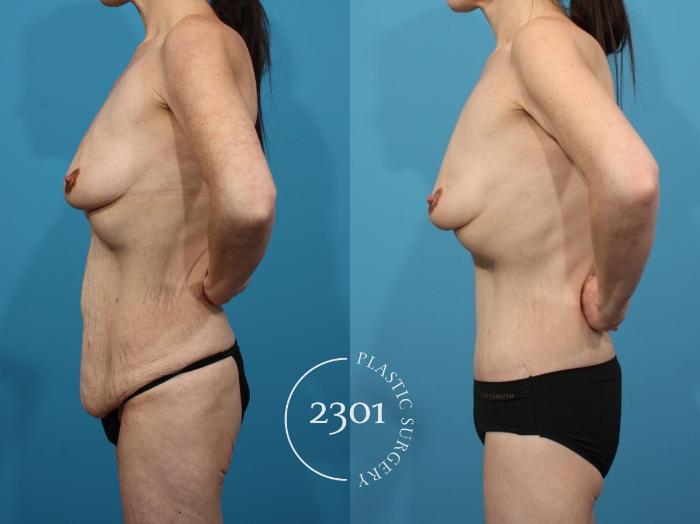 Before & After Body Lift Case 807 Left Side View in Fort Worth, Plano, & Frisco, Texas