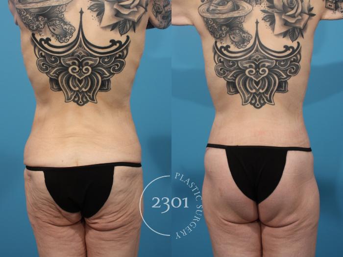 Before & After Body Lift Case 869 Back View in Fort Worth, Plano, & Frisco, Texas