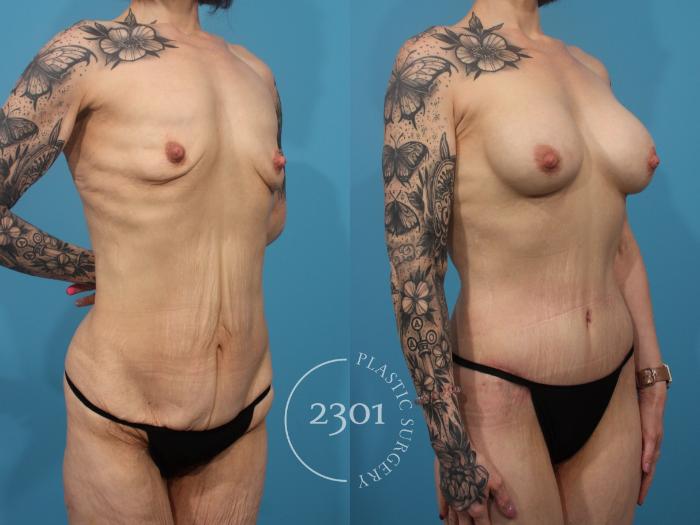 Before & After Body Lift Case 869 Right Oblique View in Fort Worth, Plano, & Frisco, Texas