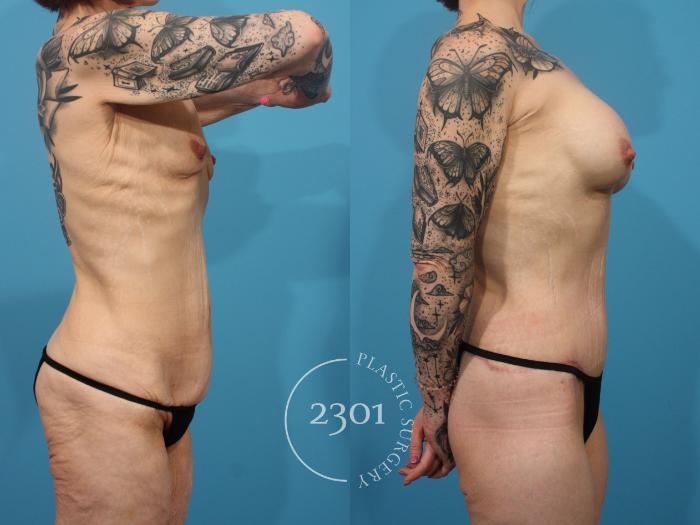 Before & After Body Lift Case 869 Right Side View in Fort Worth, Plano, & Frisco, Texas
