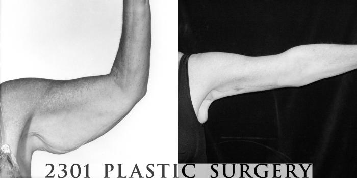Before & After Brachioplasty Case 56 View #1 View in Fort Worth & Frisco, Texas