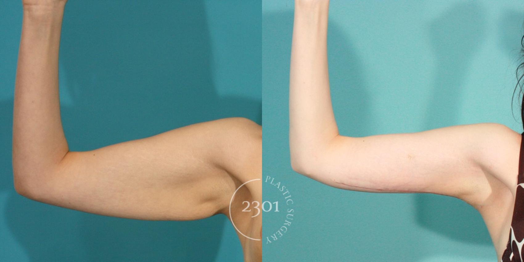 Foto de A before and after view of a successful brachioplasty procedure. An  untoned arm is seen on the left before plastic surgery, and a toned arm is  seen on the right