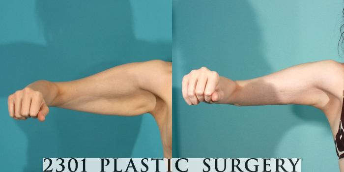 Before & After Brachioplasty Case 77 View #2 View in Fort Worth & Frisco, Texas