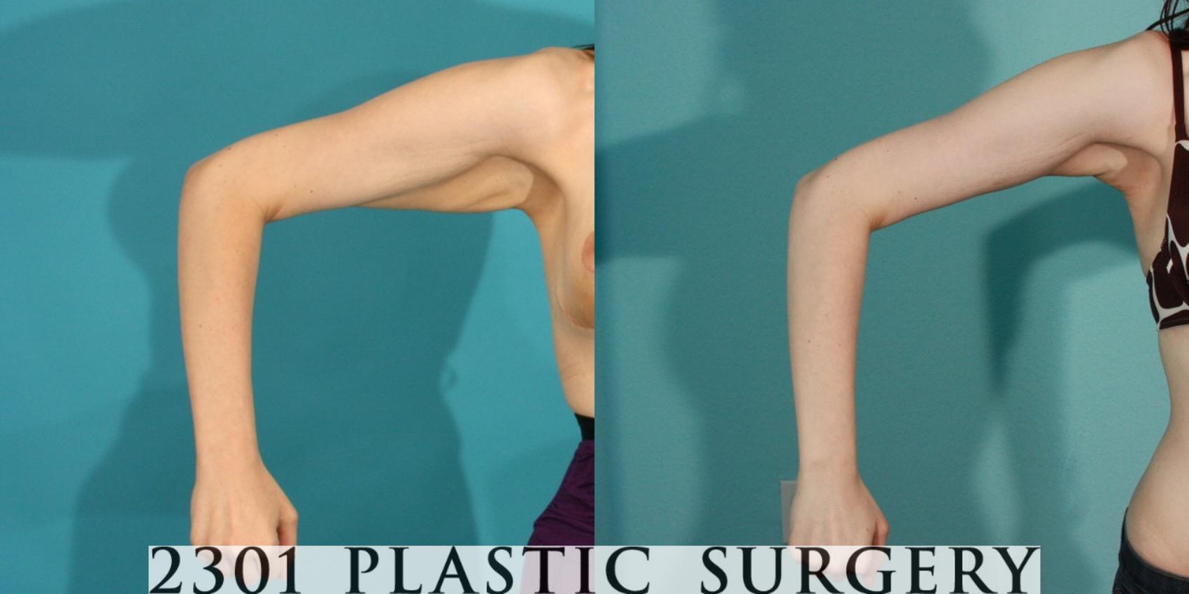 Before & After Brachioplasty Case 77 View #3 View in Fort Worth & Frisco, Texas