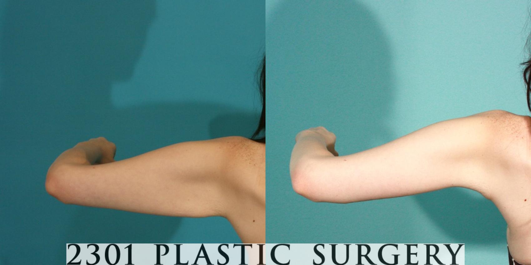Before & After Brachioplasty Case 77 View #8 View in Fort Worth & Frisco, Texas