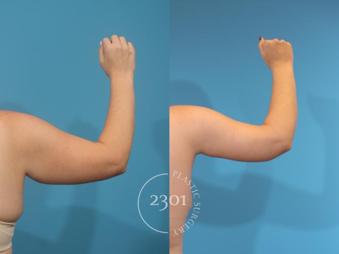 Before & After Brachioplasty Case 927 Back View in Fort Worth, Plano, & Frisco, Texas