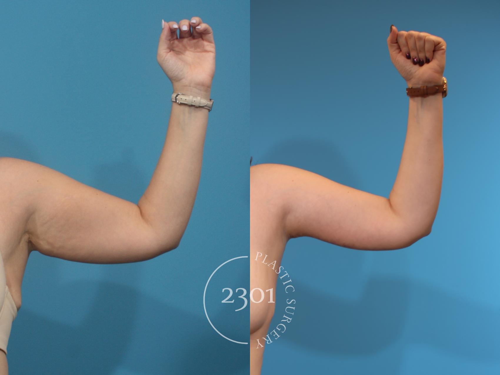 Before & After Brachioplasty Case 927 Front View in Fort Worth, Plano, & Frisco, Texas