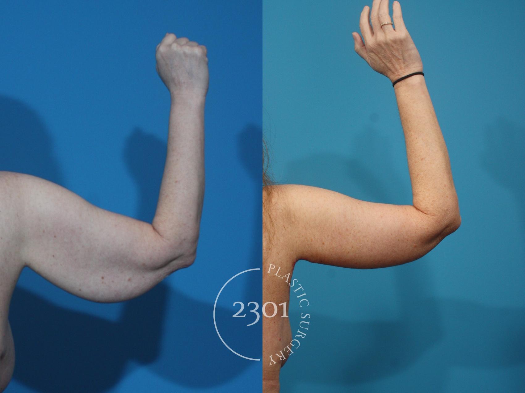 Before & After Brachioplasty Case 928 Back View in Fort Worth, Plano, & Frisco, Texas