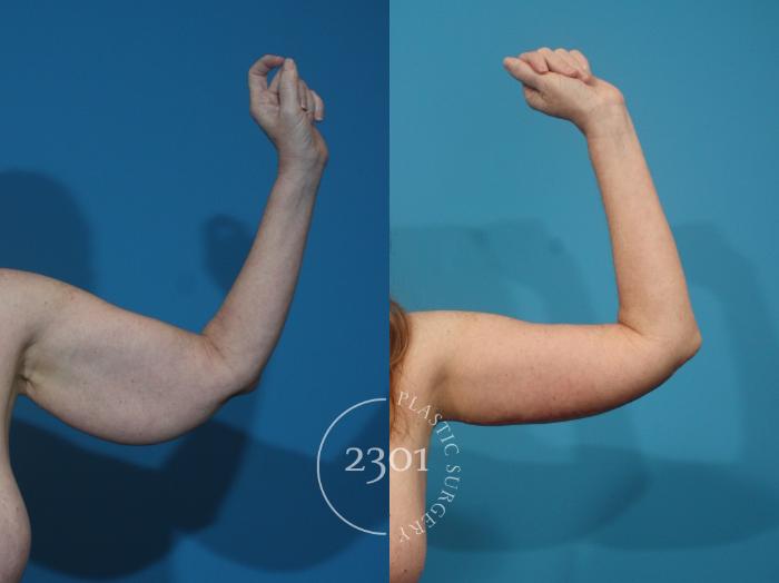Before & After Brachioplasty Case 928 Front View in Fort Worth, Plano, & Frisco, Texas