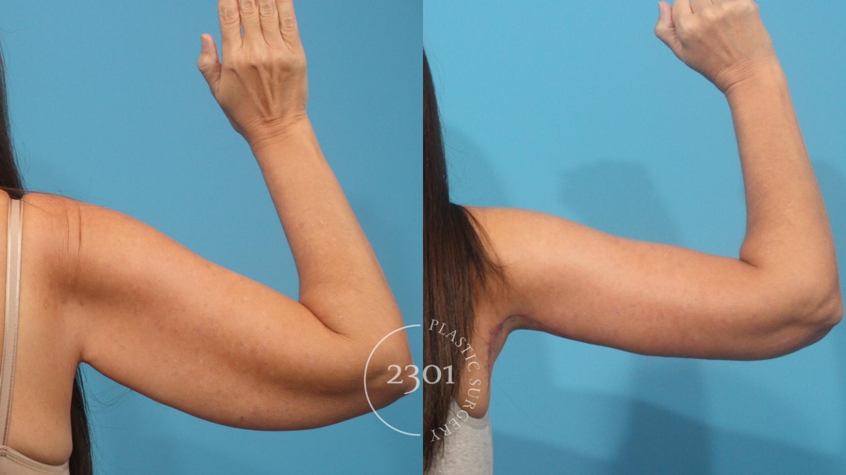 Before & After Brachioplasty Case 929 Back View in Fort Worth, Plano, & Frisco, Texas