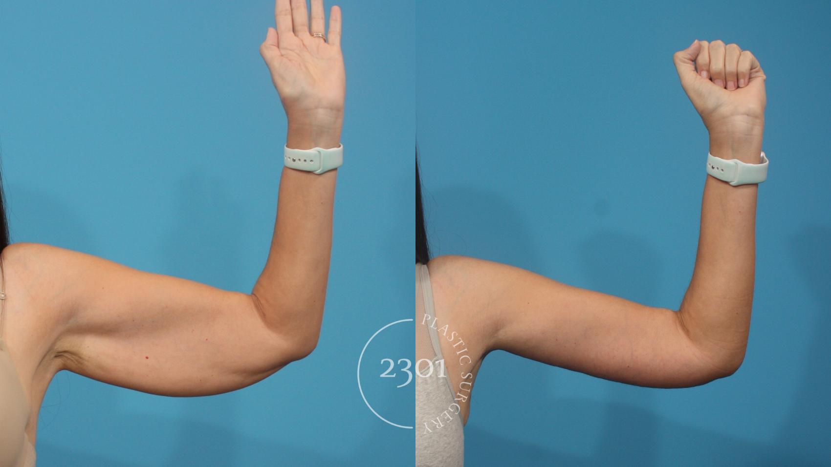Before & After Brachioplasty Case 929 Front View in Fort Worth, Plano, & Frisco, Texas