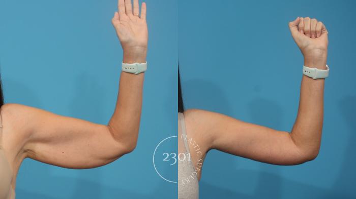 Before & After Brachioplasty Case 929 Front View in Fort Worth, Plano, & Frisco, Texas