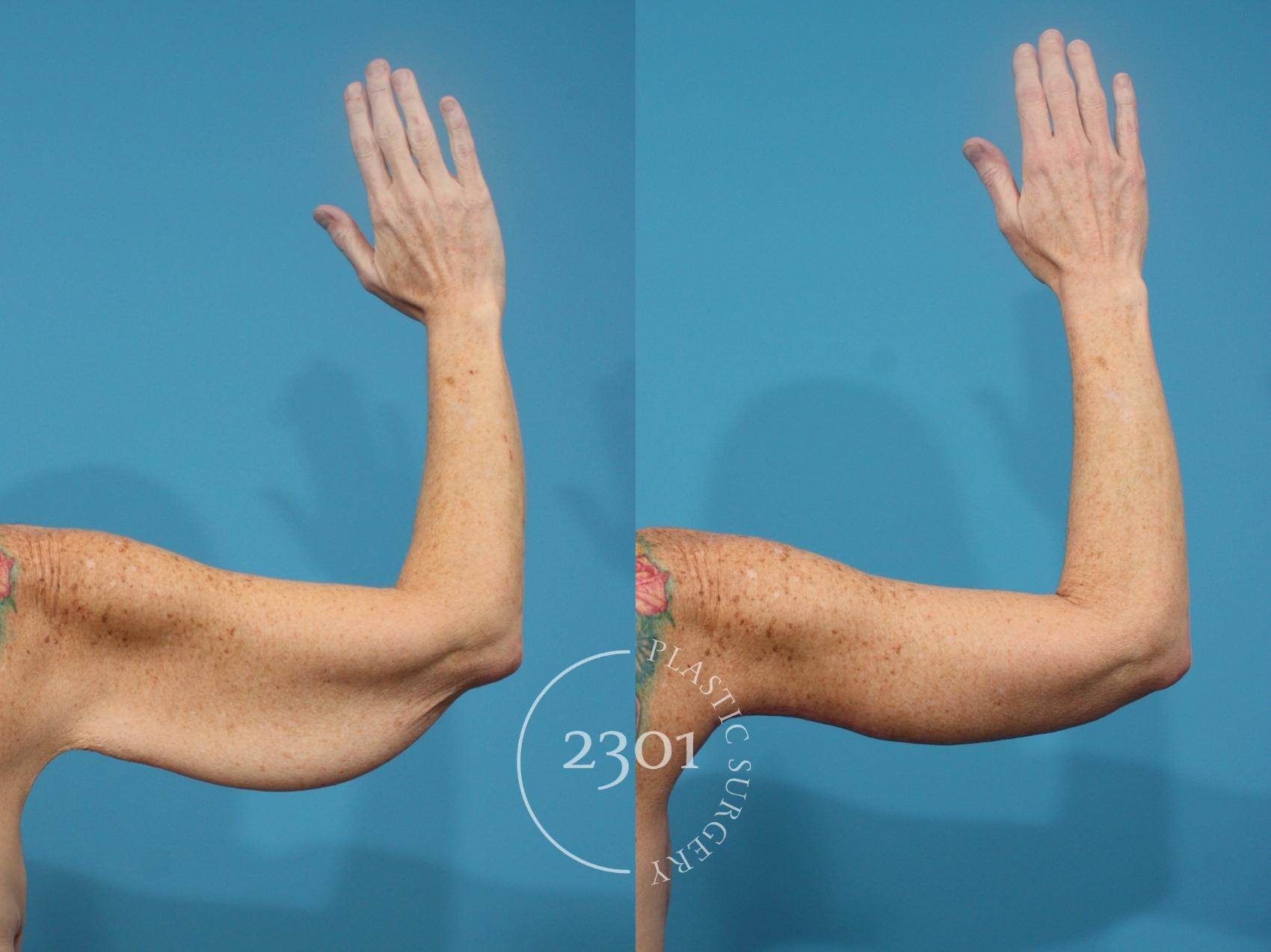 Before & After Brachioplasty Case 930 Back View in Fort Worth, Plano, & Frisco, Texas