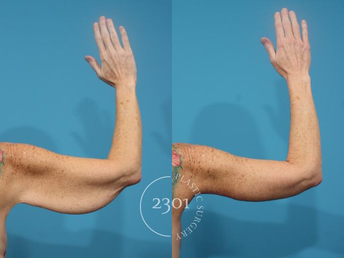 Before & After Brachioplasty Case 930 Back View in Fort Worth, Plano, & Frisco, Texas