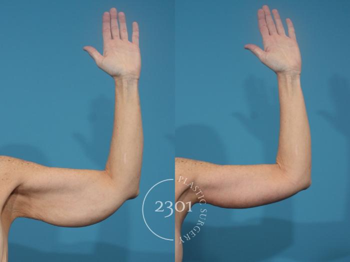 Before & After Brachioplasty Case 930 Front View in Fort Worth, Plano, & Frisco, Texas