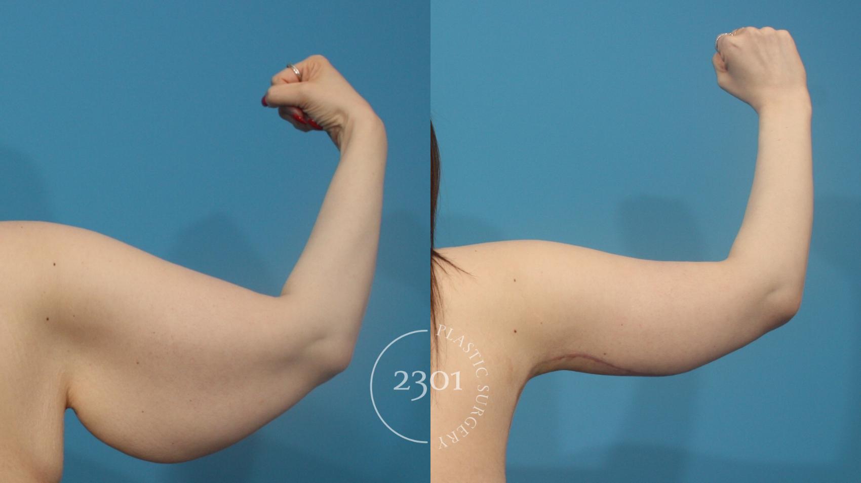 Before & After Brachioplasty Case 931 Back View in Fort Worth, Plano, & Frisco, Texas
