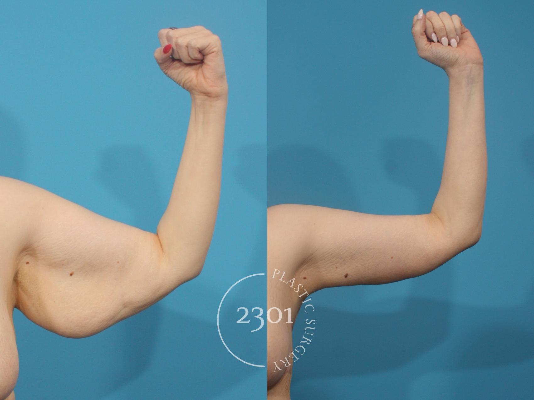 Before & After Brachioplasty Case 931 Front View in Fort Worth, Plano, & Frisco, Texas