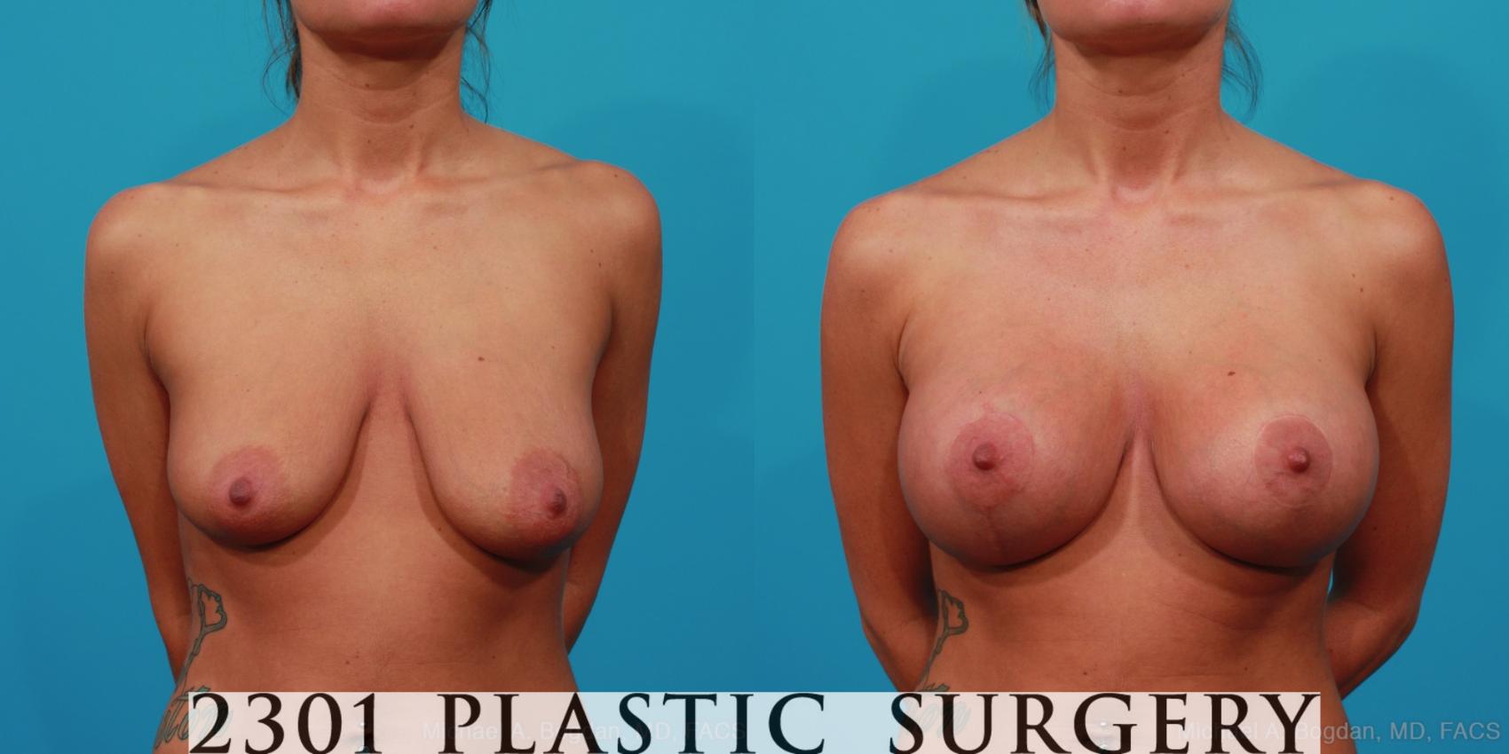 Before & After Mastopexy & Augmentation Case 241 View #1 View in Fort Worth & Frisco, Texas