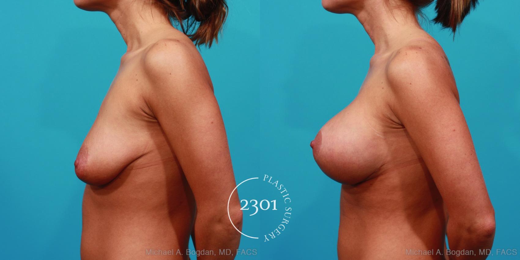 Before & After Mastopexy & Augmentation Case 241 View #2 View in Fort Worth, Plano, & Frisco, Texas