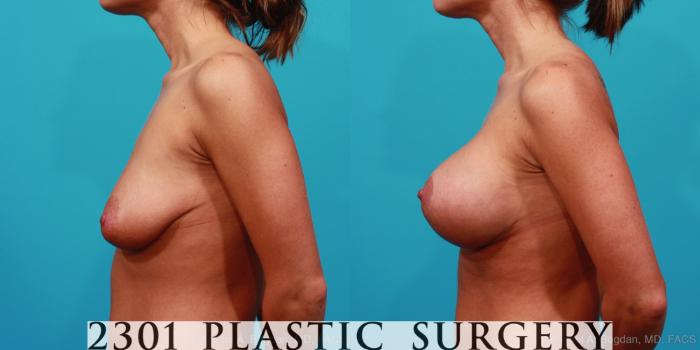 Before & After Mastopexy & Augmentation Case 241 View #2 View in Fort Worth, Plano, & Frisco, Texas