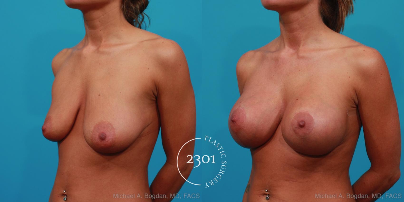Before & After Mastopexy & Augmentation Case 241 View #3 View in Fort Worth, Plano, & Frisco, Texas