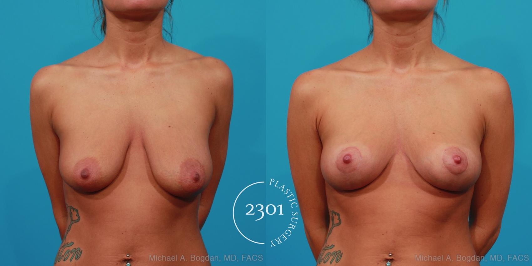 Before & After Mastopexy & Augmentation Case 241 View #4 View in Fort Worth, Plano, & Frisco, Texas
