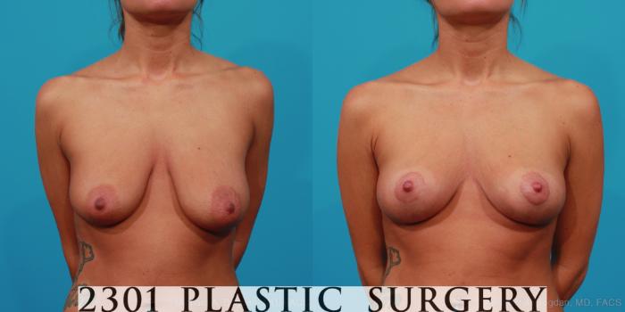 Before & After Breast Augmentation Case 241 View #4 View in Fort Worth, Plano, & Frisco, Texas